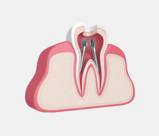 Myths About Root Canals