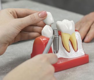 Why Dental Implants Improve Quality of Life