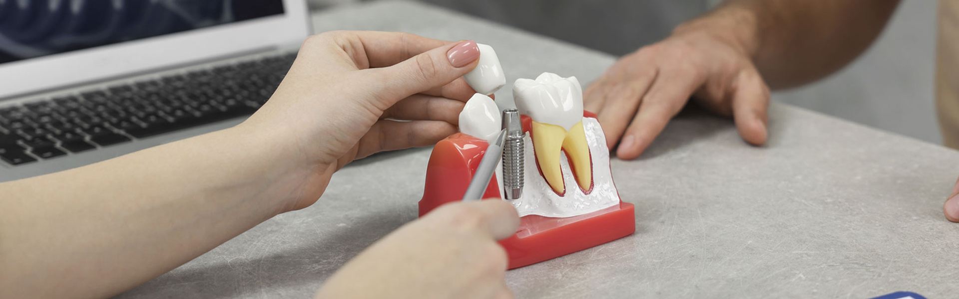 Why Dental Implants Improve Quality of Life
