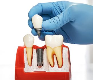 Why Dental Implants Are Low Maintenance