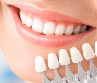 5 Dental Problems Veneers Can Fix: A Complete Guide